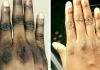 Dermatologists Warn Nigerians Against the Dangers of Skin Bleaching