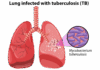 Tuberculosis Killed 1.23 Million Globally in 2024 – WHO Warns of Fragile Progress. Lungs infected with Tuberculosis